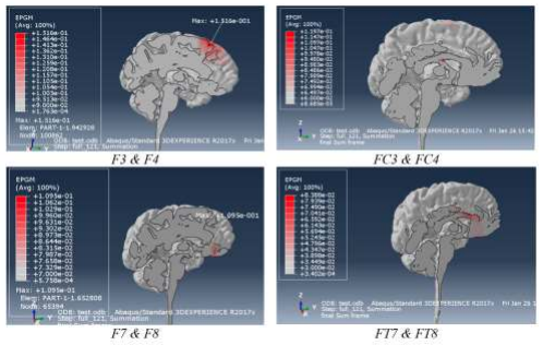 Schizophrenia_Brain_Scans