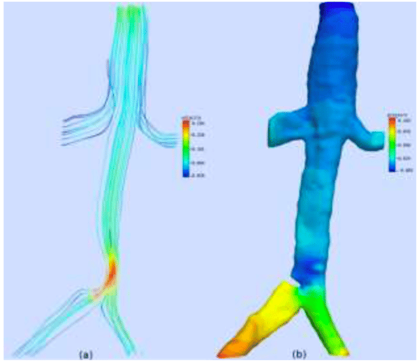 openfoam-cardiovascular